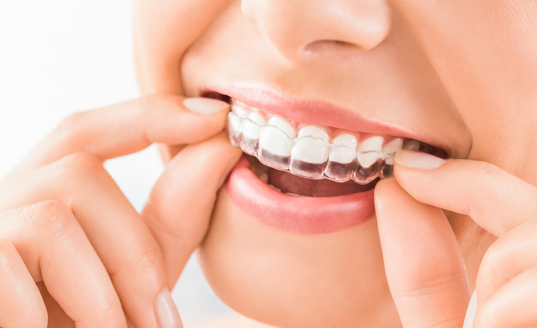 Invisalign in Memorial, Houston