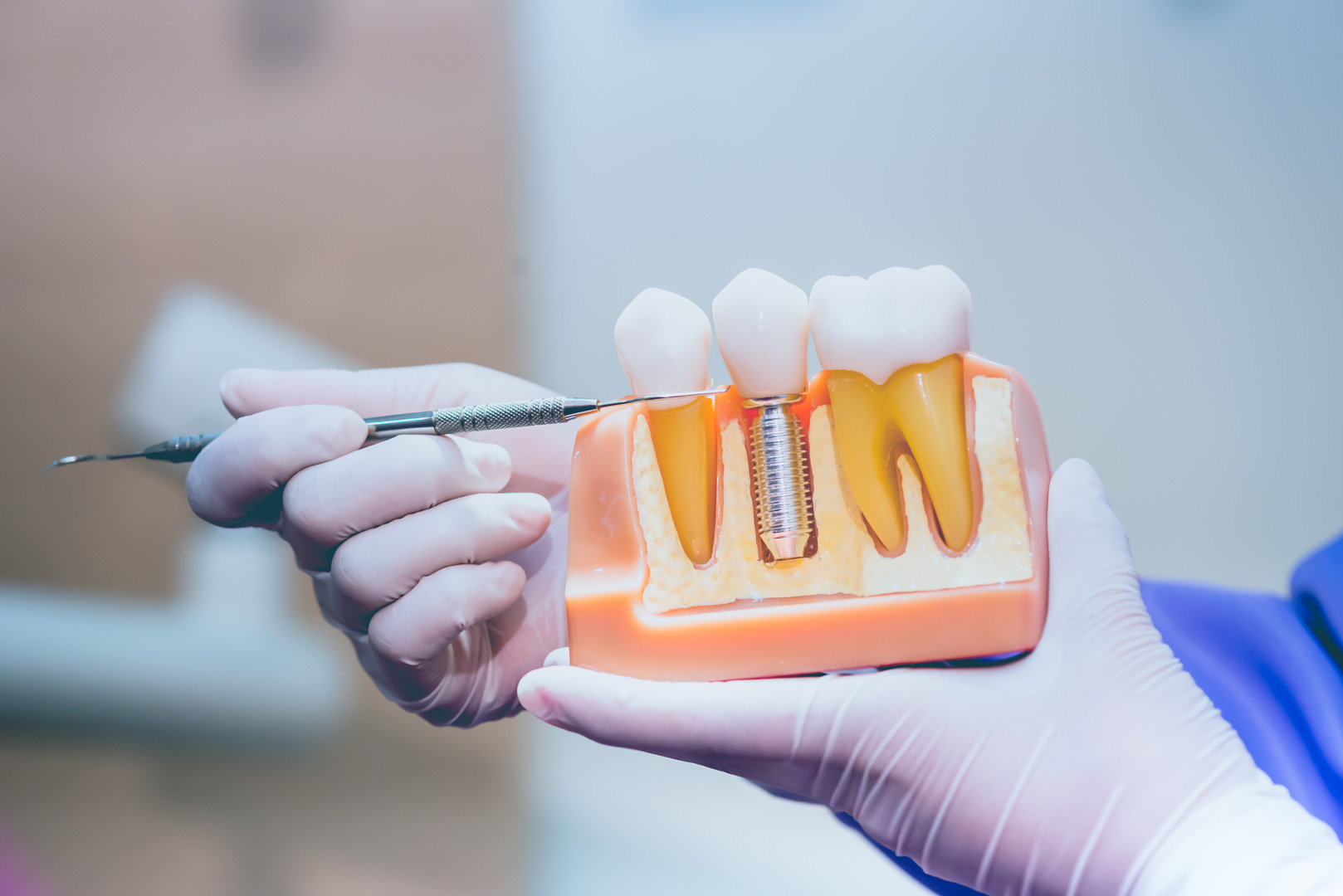 Dental Implants in Memorial, Houston