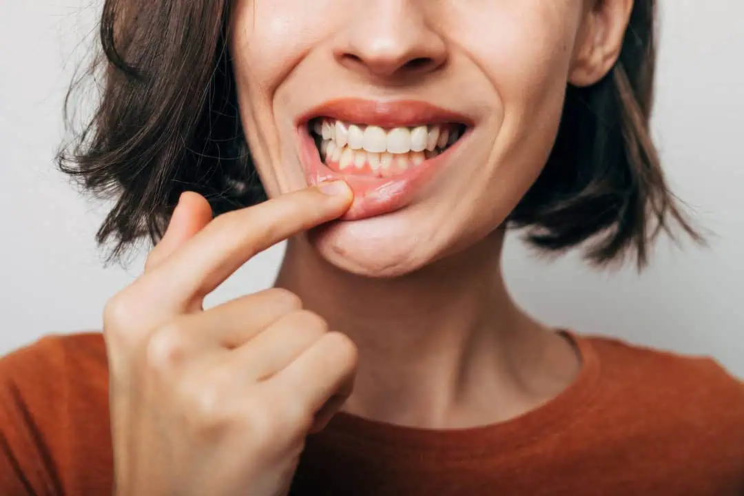 How to Treat Gum Disease: A Step-by-Step Guide